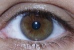 Irisdiagnose